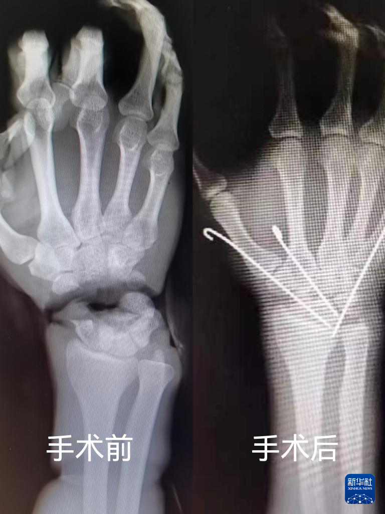 ８時間の手術で切断された手首を再接着 四川省成都市